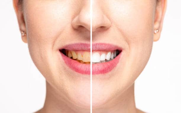 Teeth Whitening Milton Keynes Essex