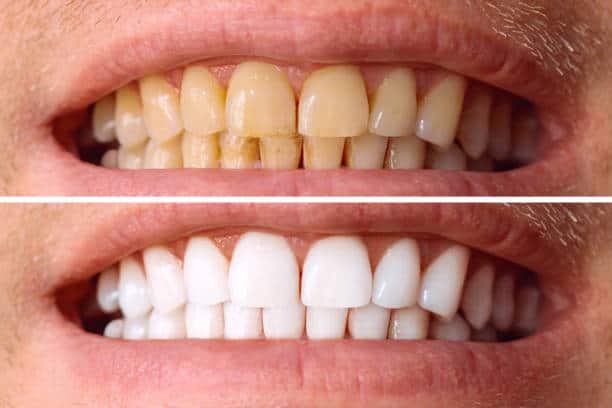 Laser White For Ever Bright – Get a Brighter, Whiter Smile with LA Teeth Whitening Essex