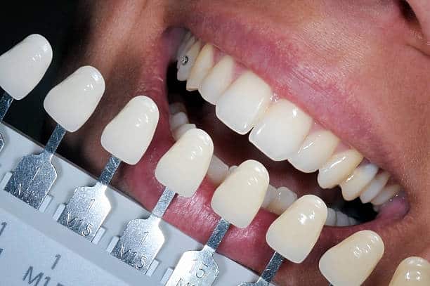 Get Natural and Stunning Smile with Teeth Whitening Results from LA Teeth Whitening Essex