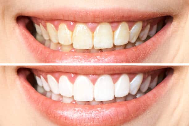 Achieve a Dazzling Smile for Your Special Day: A Guide to Wedding Teeth Whitening Essex