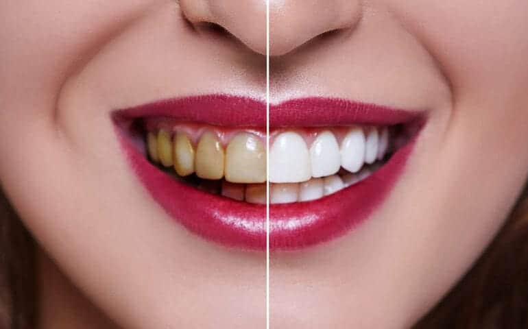 Teeth Whitening Ascot Windsor Essex