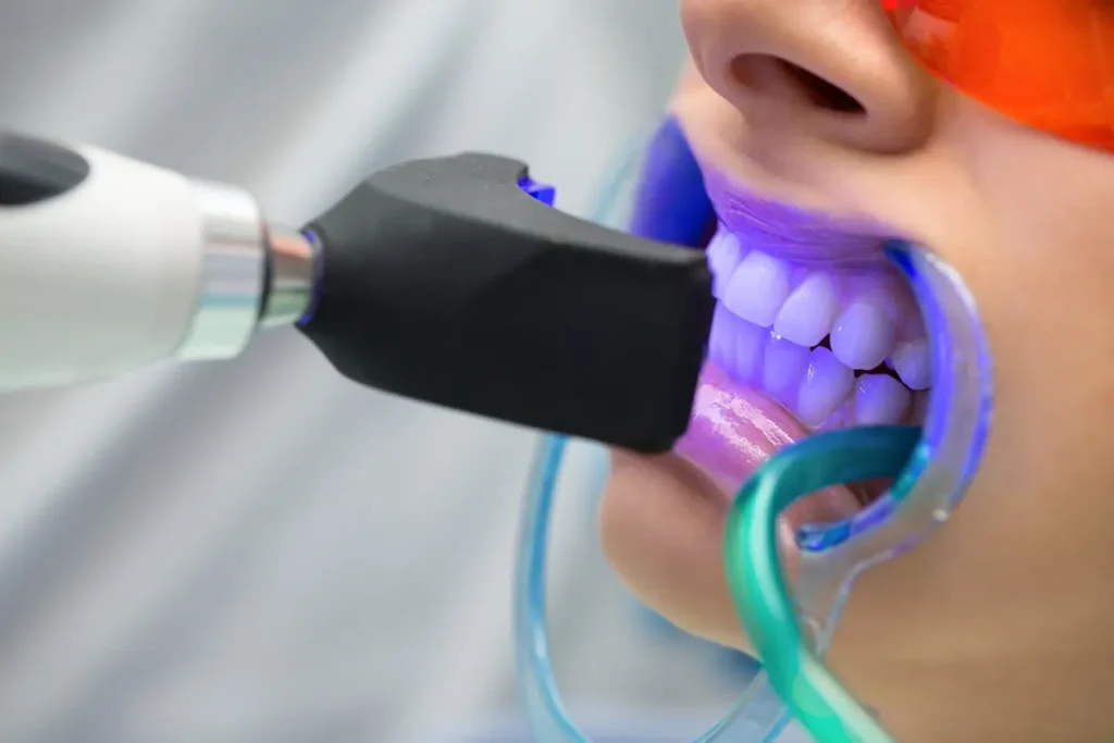 Will I See Immediate Results from Lazer Teeth Whitening Essex