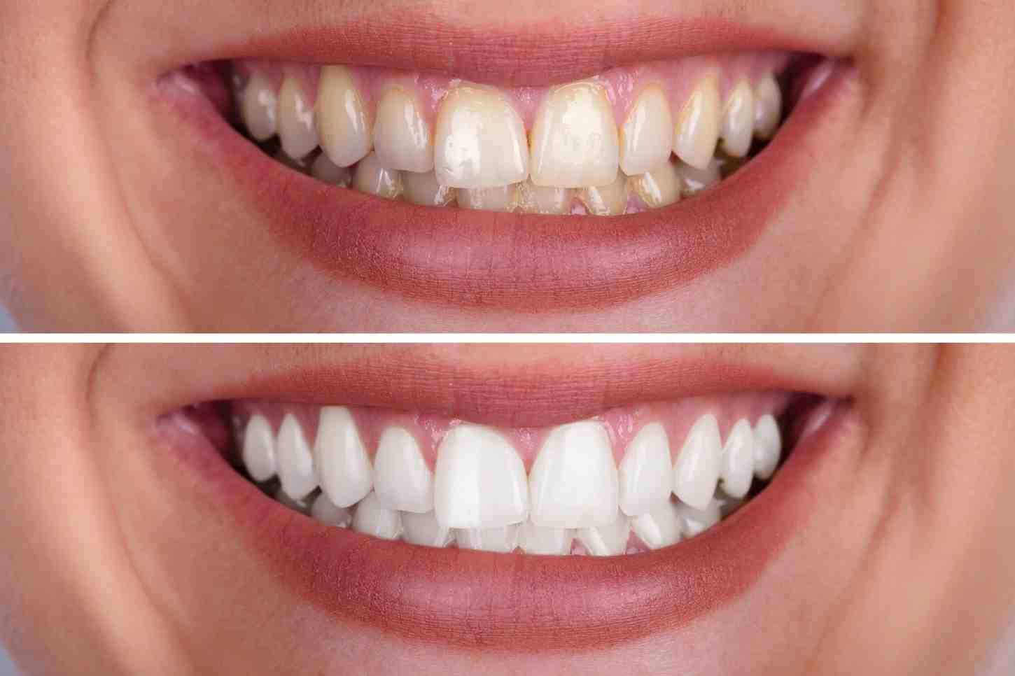 Can Teeth Whitening Fix Uneven Colour — Or Will It Just Make It Worse Essex
