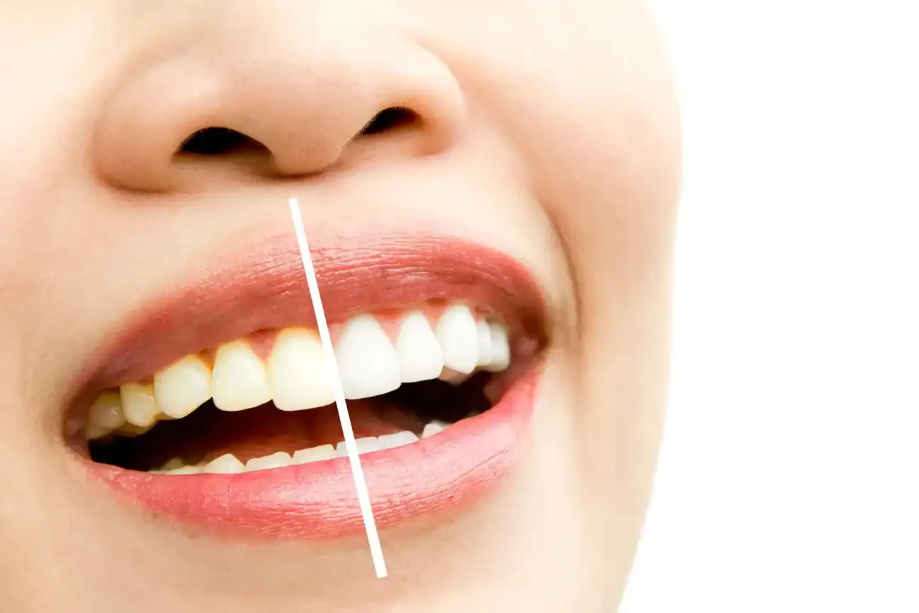How Can I Protect My Teeth Before and After Whitening with Enamel Loss Essex