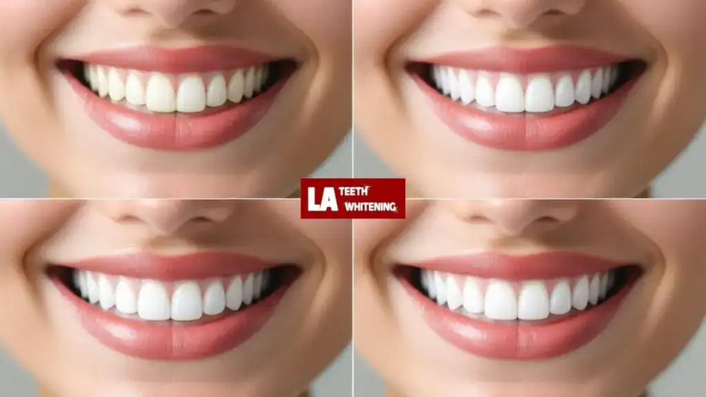 Whitening Before or After Getting Veneers: What’s Best Essex